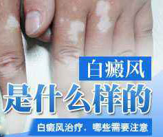 白癜风初期有哪些症状